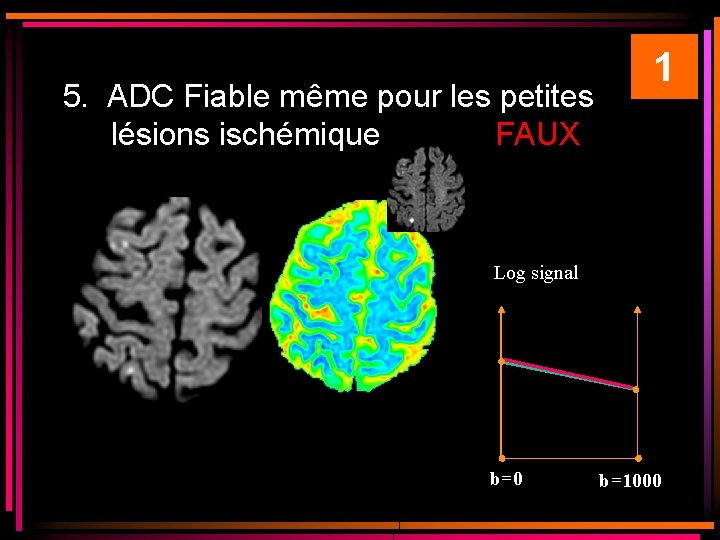 5. ADC Fiable même pour les petites lésions ischémique FAUX 1 Log signal ADC 5. ADC Fiable même pour les petites lésions ischémique FAUX 1 Log signal ADC