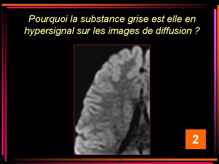 Pourquoi la substance grise est elle en hypersignal sur les images de diffusion ? Pourquoi la substance grise est elle en hypersignal sur les images de diffusion ?