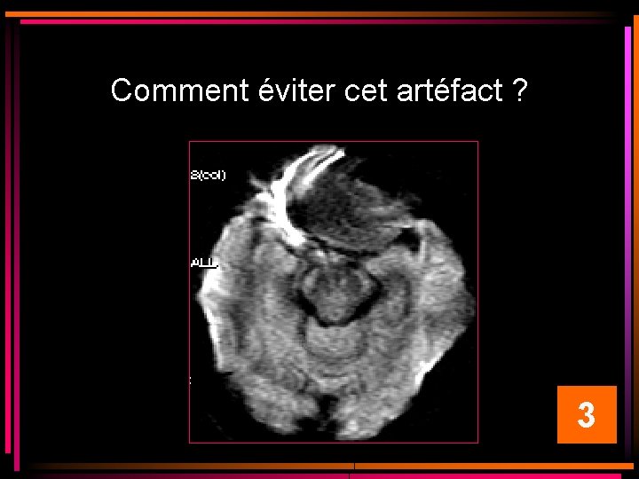 Comment éviter cet artéfact ? 3 Comment éviter cet artéfact ? 3