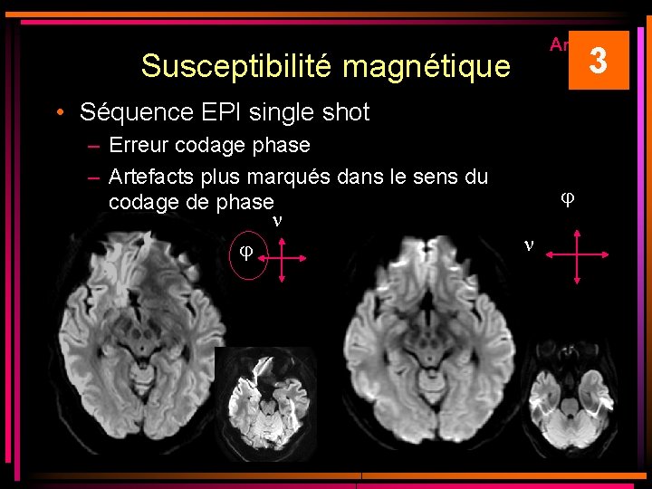 Artéfacts 3 Susceptibilité magnétique • Séquence EPI single shot – Erreur codage phase – Artéfacts 3 Susceptibilité magnétique • Séquence EPI single shot – Erreur codage phase –