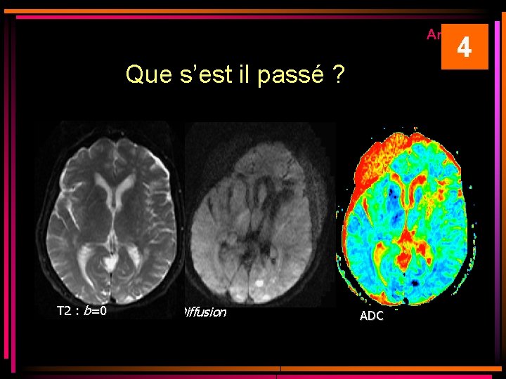 Artéfacts 4 Que s’est il passé ? T 2 : b=0 Diffusion ADC Artéfacts 4 Que s’est il passé ? T 2 : b=0 Diffusion ADC