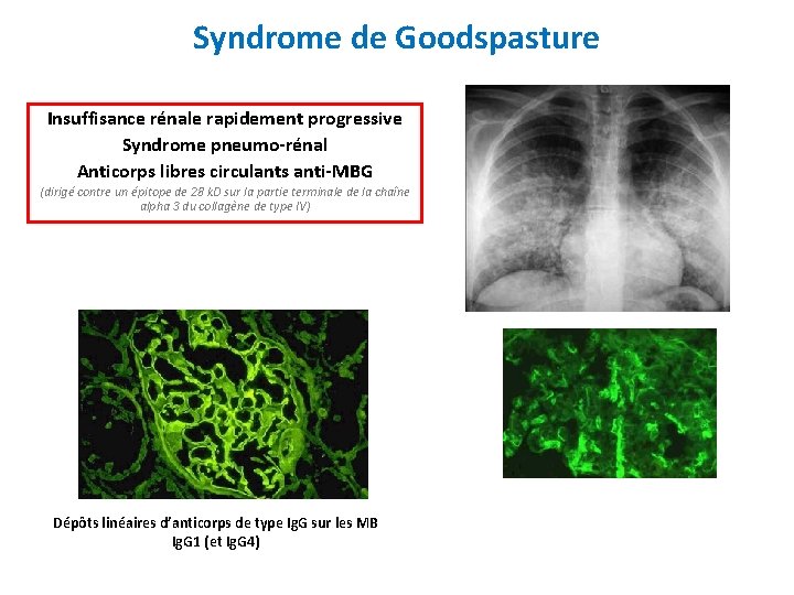 Syndrome de Goodspasture Insuffisance rénale rapidement progressive Syndrome pneumo-rénal Anticorps libres circulants anti-MBG (dirigé