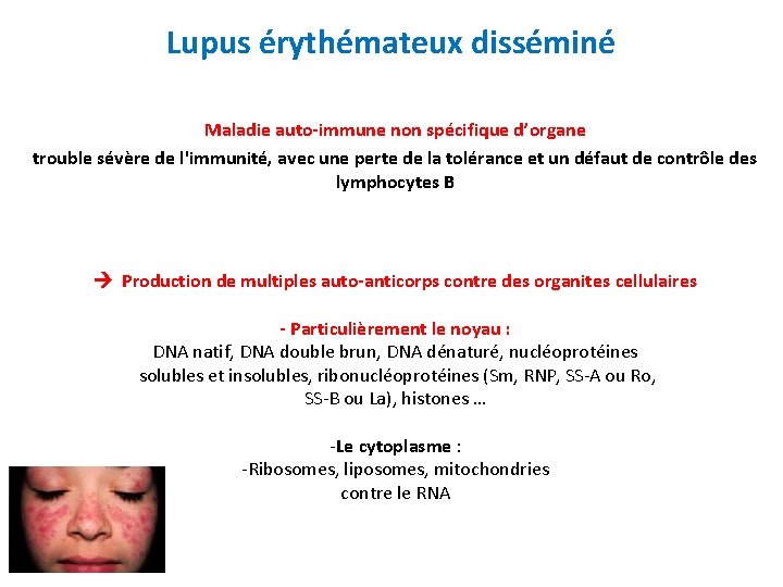 Lupus érythémateux disséminé Maladie auto-immune non spécifique d’organe trouble sévère de l'immunité, avec une