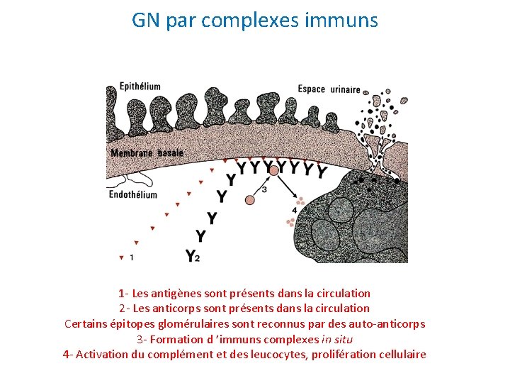 GN par complexes immuns Lupus Erythémateux Disséminé 1 - Les antigènes sont présents dans
