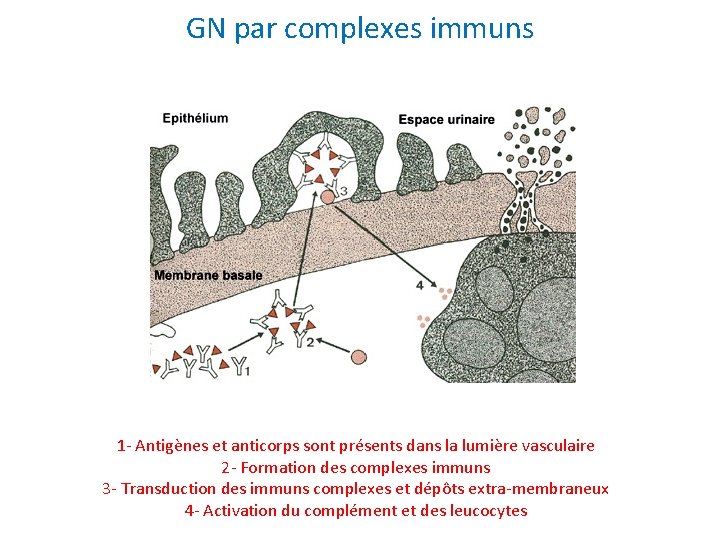 GN par complexes immuns 1 - Antigènes et anticorps sont présents dans la lumière