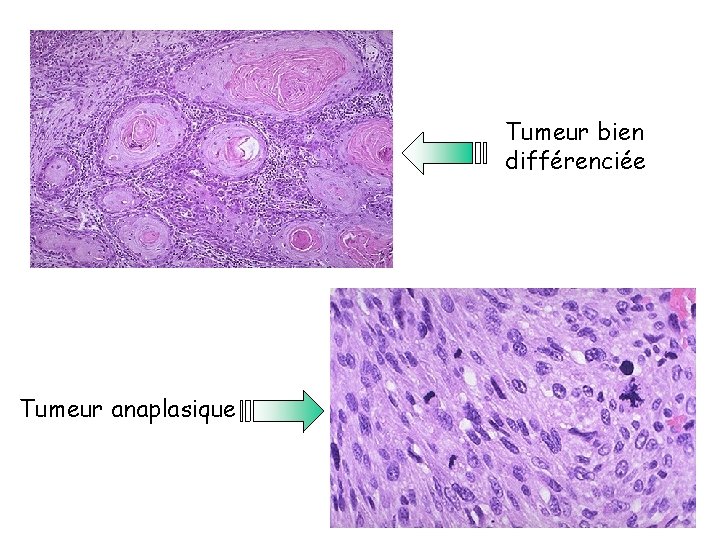 Tumeur bien différenciée Tumeur anaplasique 