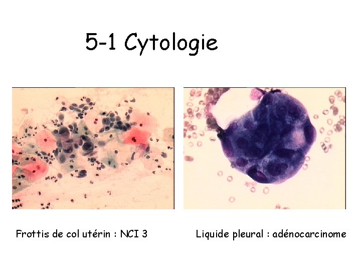 5 -1 Cytologie Frottis de col utérin : NCI 3 Liquide pleural : adénocarcinome