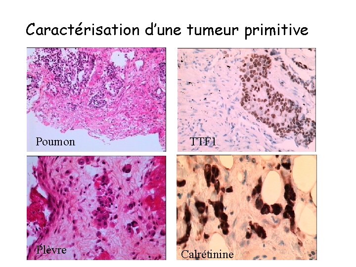 Caractérisation d’une tumeur primitive Poumon Plèvre TTF 1 Calrétinine 