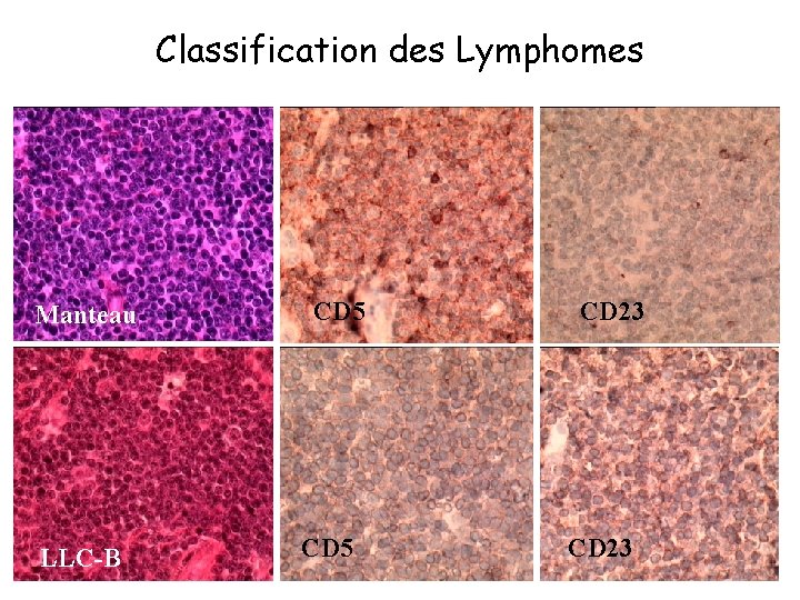 Classification des Lymphomes Manteau LLC-B CD 5 CD 23 