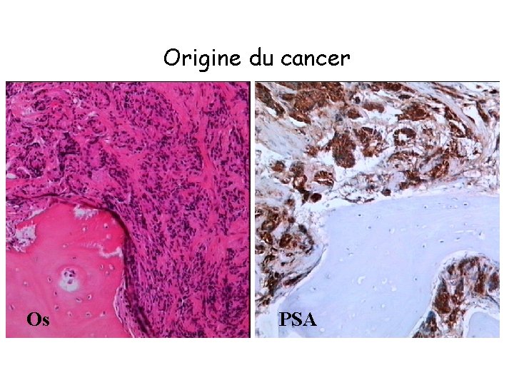 Origine du cancer Os PSA 