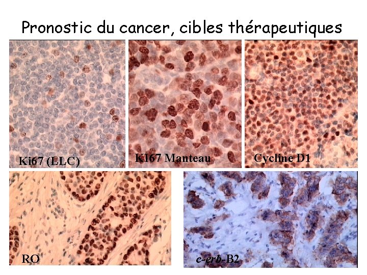 Pronostic du cancer, cibles thérapeutiques Ki 67 (LLC) RO KI 67 Manteau c-erb-B 2