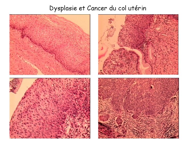 Dysplasie et Cancer du col utérin 