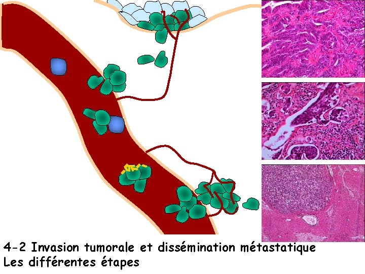 4 -2 Invasion tumorale et dissémination métastatique Les différentes étapes 