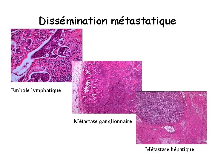 Dissémination métastatique Embole lymphatique Métastase ganglionnaire Métastase hépatique 
