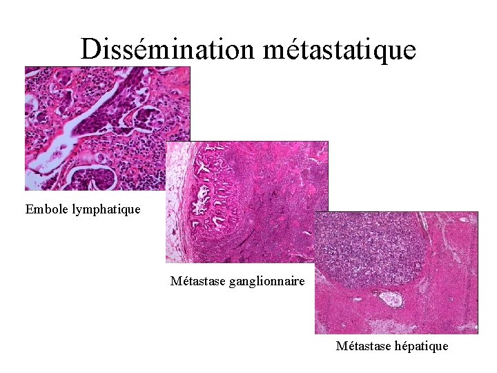 Dissémination métastatique Embole lymphatique Métastase ganglionnaire Métastase hépatique 