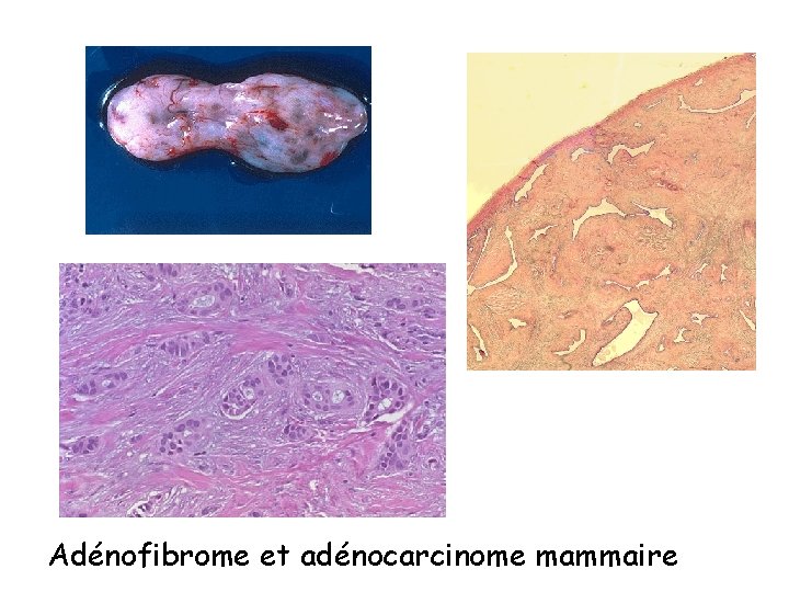 Adénofibrome et adénocarcinome mammaire 