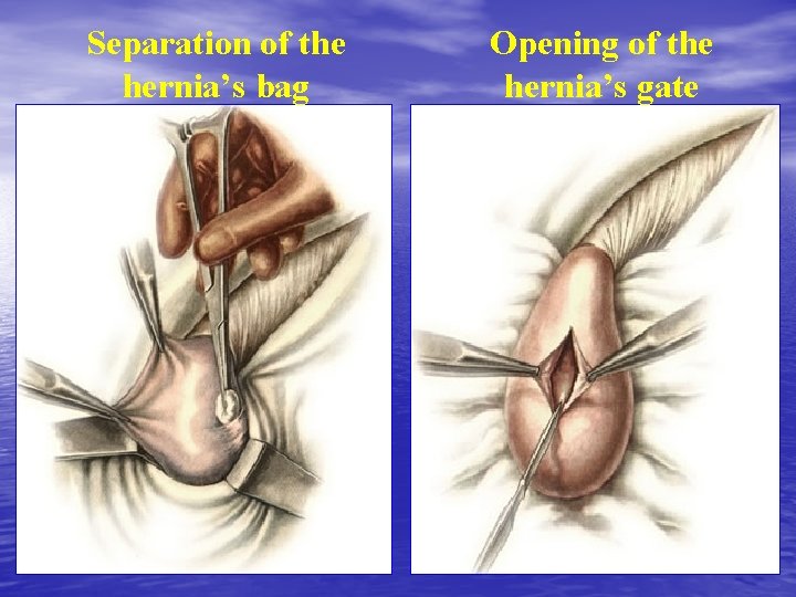 Separation of the hernia’s bag Opening of the hernia’s gate 