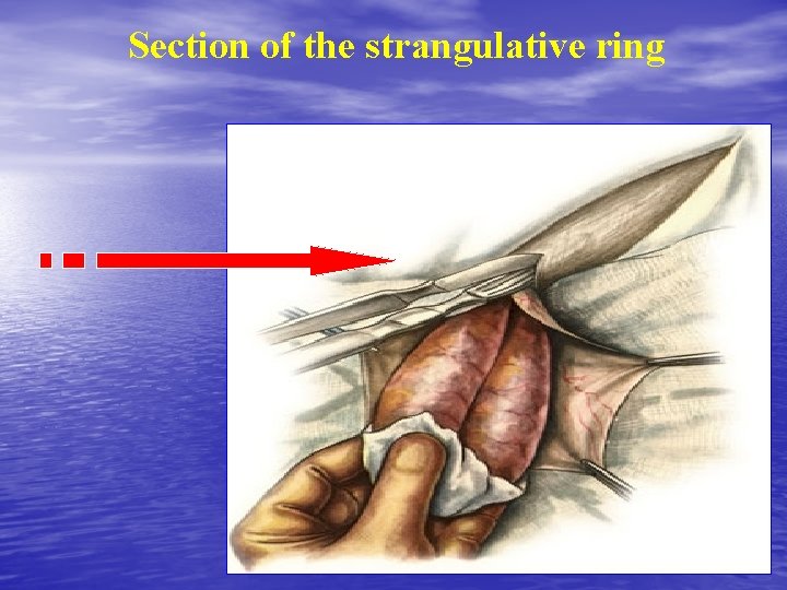 Section of the strangulative ring 