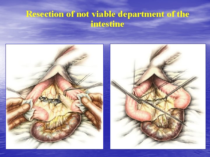 Resection of not viable department of the intestine 