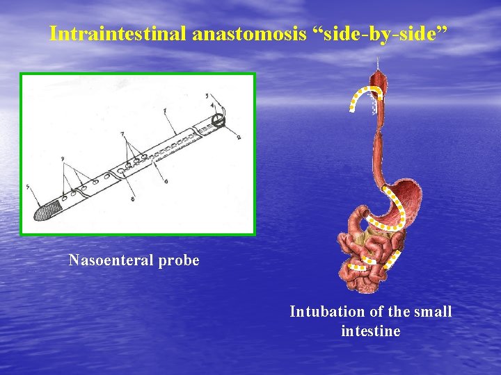 Intraintestinal anastomosis “side-by-side” Nasoenteral probe Intubation of the small intestine 