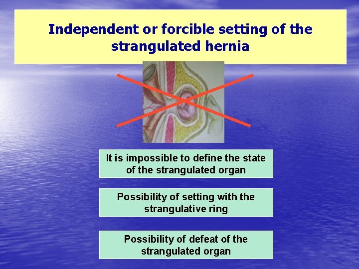 Independent or forcible setting of the strangulated hernia It is impossible to define the