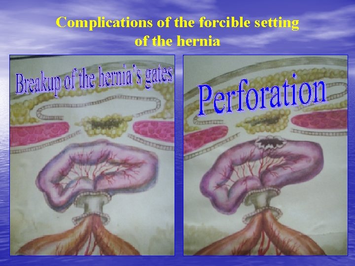 Complications of the forcible setting of the hernia 