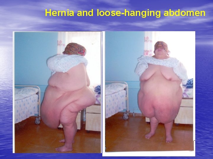 Hernia and loose-hanging abdomen 