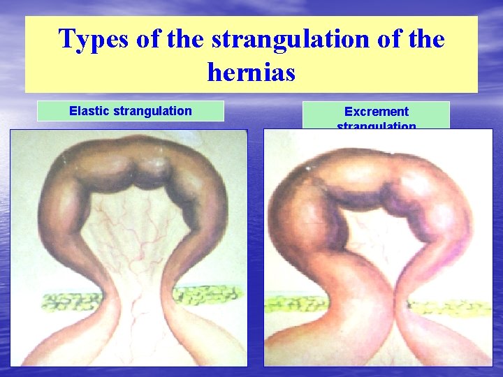 Types of the strangulation of the hernias Elastic strangulation Excrement strangulation 