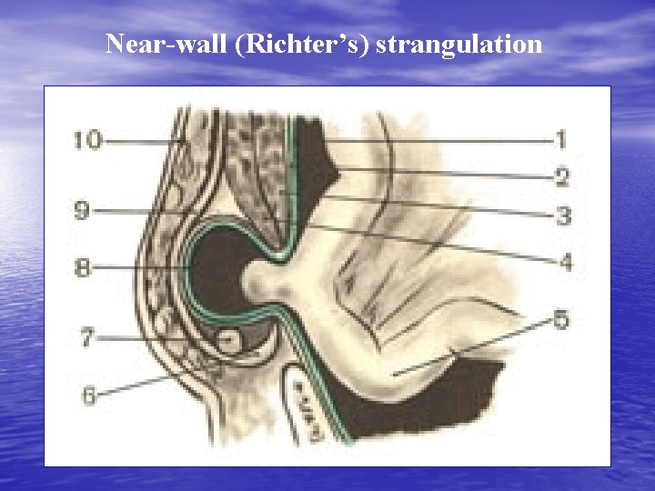 Near-wall (Richter’s) strangulation 