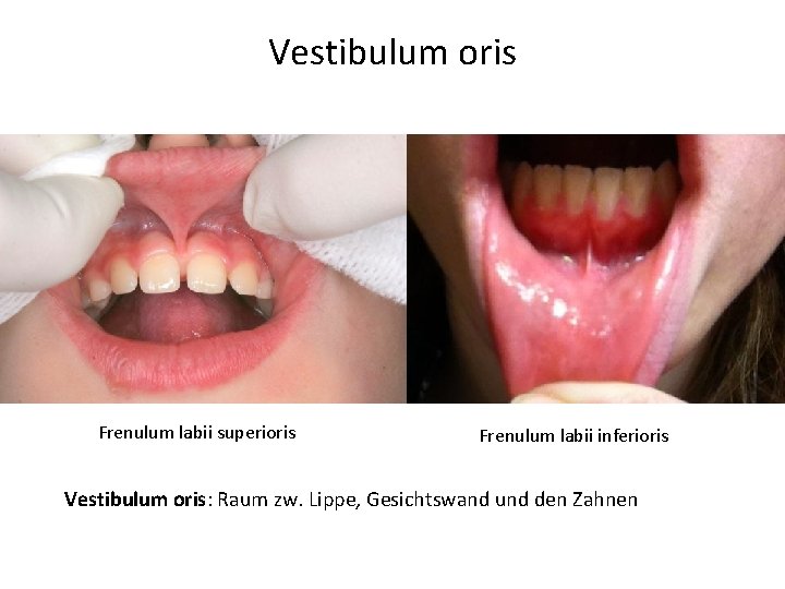 Vestibulum oris Frenulum labii superioris Frenulum labii inferioris Vestibulum oris: Raum zw. Lippe, Gesichtswand