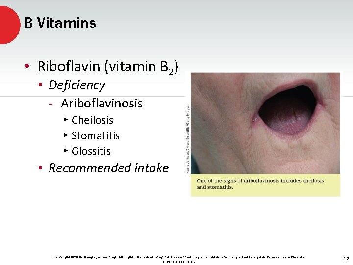 B Vitamins • Riboflavin (vitamin B 2) • Deficiency - Ariboflavinosis ▸ Cheilosis ▸