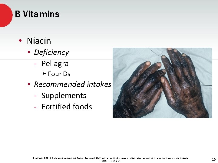 B Vitamins • Niacin • Deficiency - Pellagra ▸ Four Ds • Recommended intakes