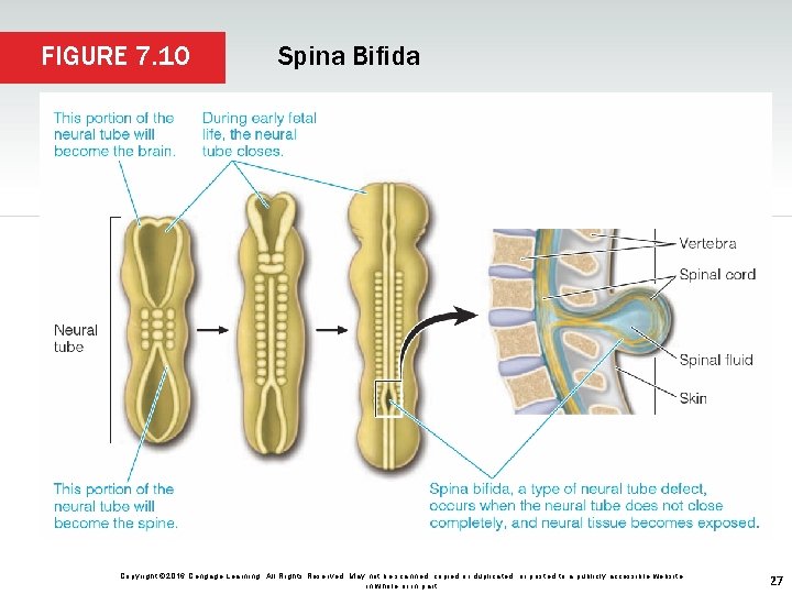 FIGURE 7. 10 Spina Bifida Copyright © 2016 Cengage Learning. All Rights Reserved. May