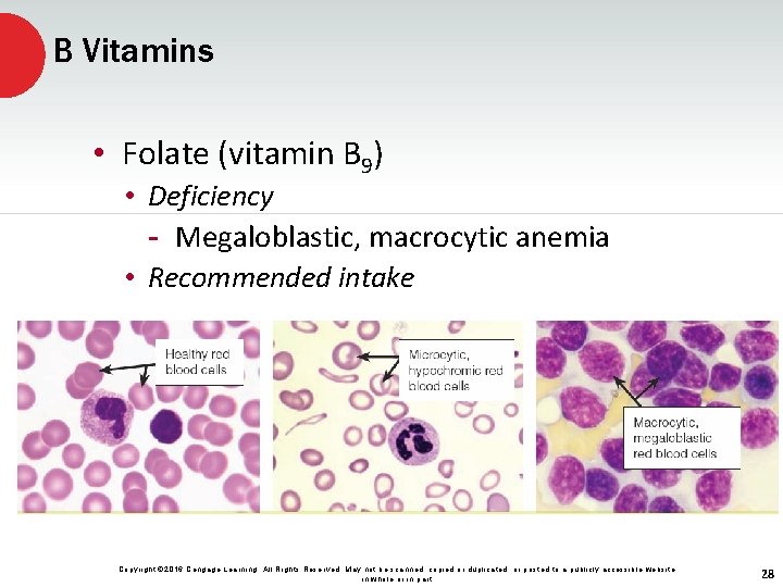 B Vitamins • Folate (vitamin B 9) • Deficiency - Megaloblastic, macrocytic anemia •