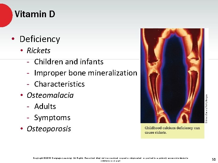 Vitamin D • Deficiency • Rickets - Children and infants - Improper bone mineralization