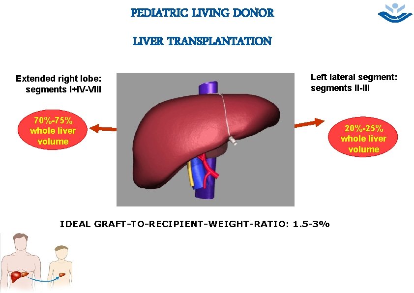 5 PEDIATRIC LIVING DONOR LIVER TRANSPLANTATION Extended right lobe: segments I+IV-VIII Left lateral segment: