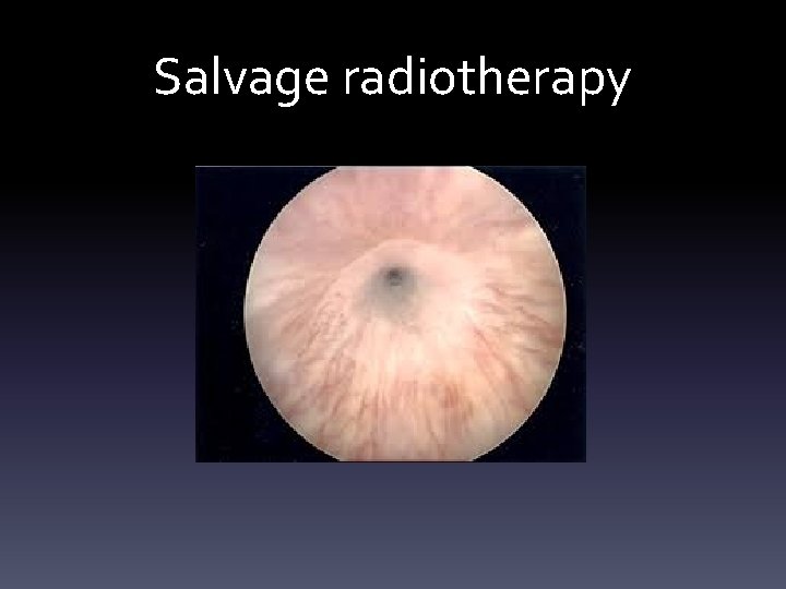 Salvage radiotherapy 