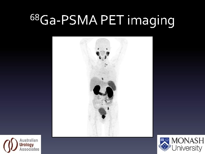 68 Ga-PSMA PET imaging 