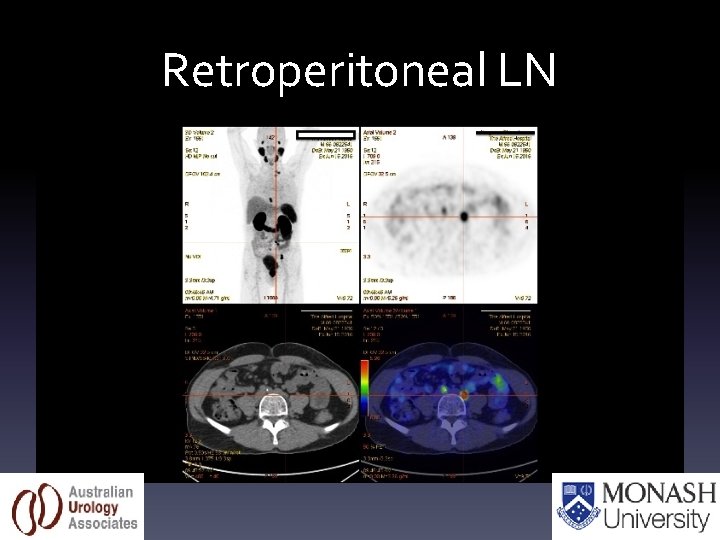 Retroperitoneal LN 