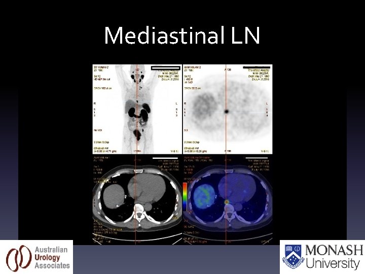 Mediastinal LN 