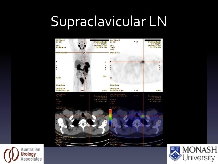 Supraclavicular LN 