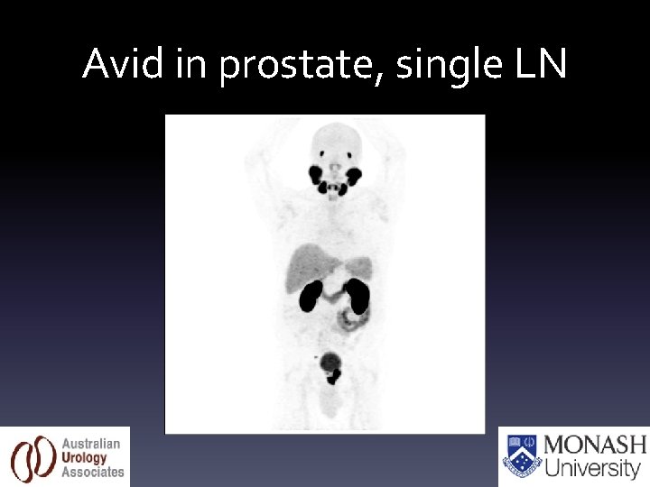 Avid in prostate, single LN 
