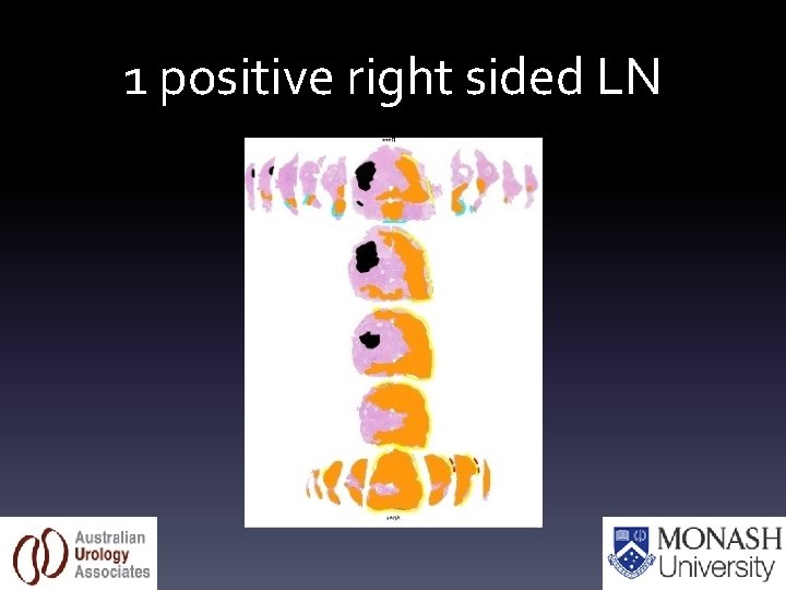 1 positive right sided LN 