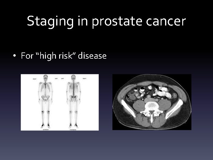 Staging in prostate cancer • For “high risk” disease 
