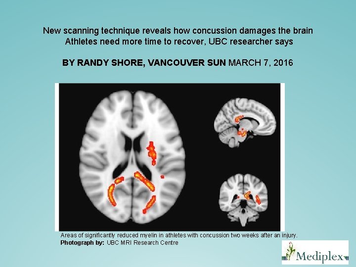 New scanning technique reveals how concussion damages the brain Athletes need more time New scanning technique reveals how concussion damages the brain Athletes need more time