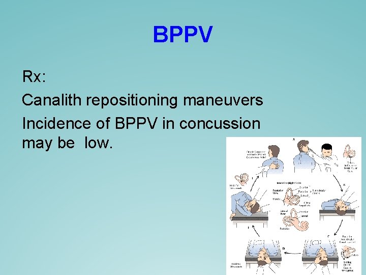 BPPV Rx: Canalith repositioning maneuvers Incidence of BPPV in concussion may be low. BPPV Rx: Canalith repositioning maneuvers Incidence of BPPV in concussion may be low.