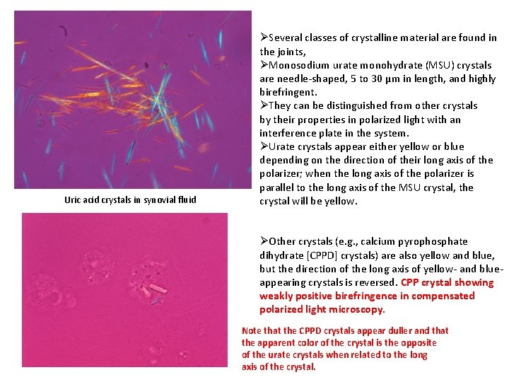 Uric acid crystals in synovial fluid ØSeveral classes of crystalline material are found in Uric acid crystals in synovial fluid ØSeveral classes of crystalline material are found in
