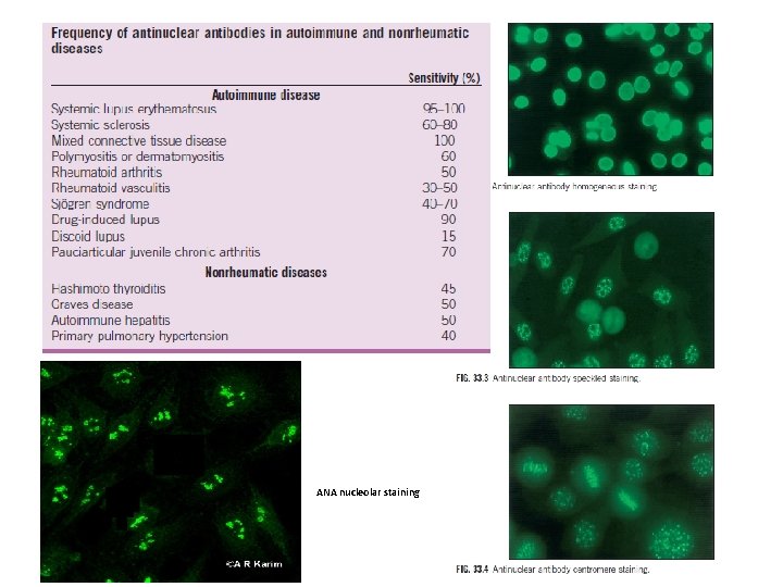 ANA nucleolar staining ANA nucleolar staining