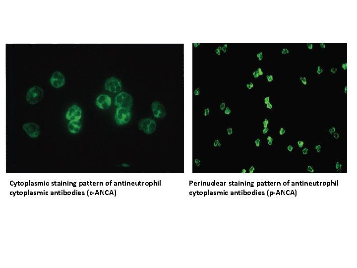 Cytoplasmic staining pattern of antineutrophil cytoplasmic antibodies (c-ANCA) Perinuclear staining pattern of antineutrophil cytoplasmic Cytoplasmic staining pattern of antineutrophil cytoplasmic antibodies (c-ANCA) Perinuclear staining pattern of antineutrophil cytoplasmic