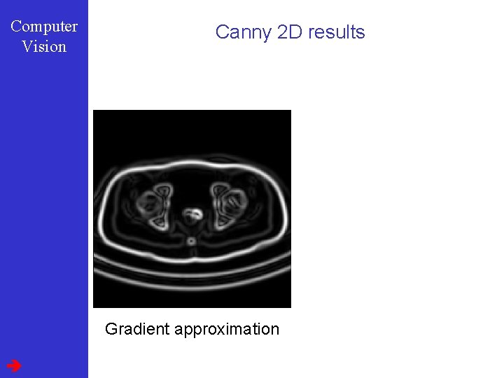 Computer Vision Canny 2 D results Gradient approximation 